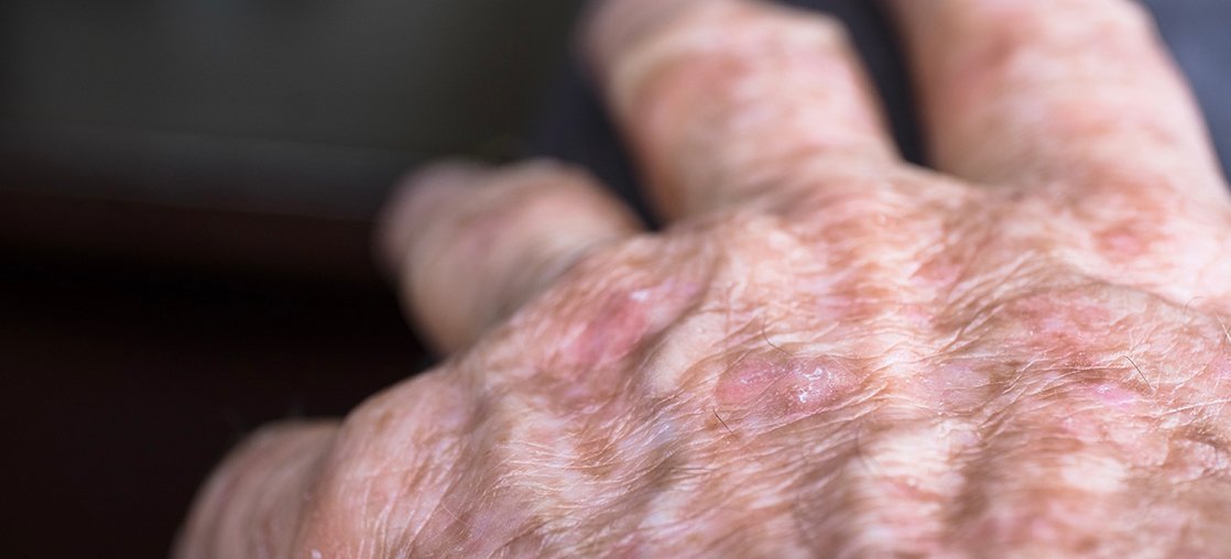 Actinic Keratosis clinical study in Bowling Green KY