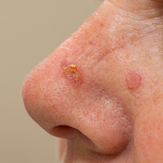 Basal Cell Carcinoma clinical study in Bowling Green KY