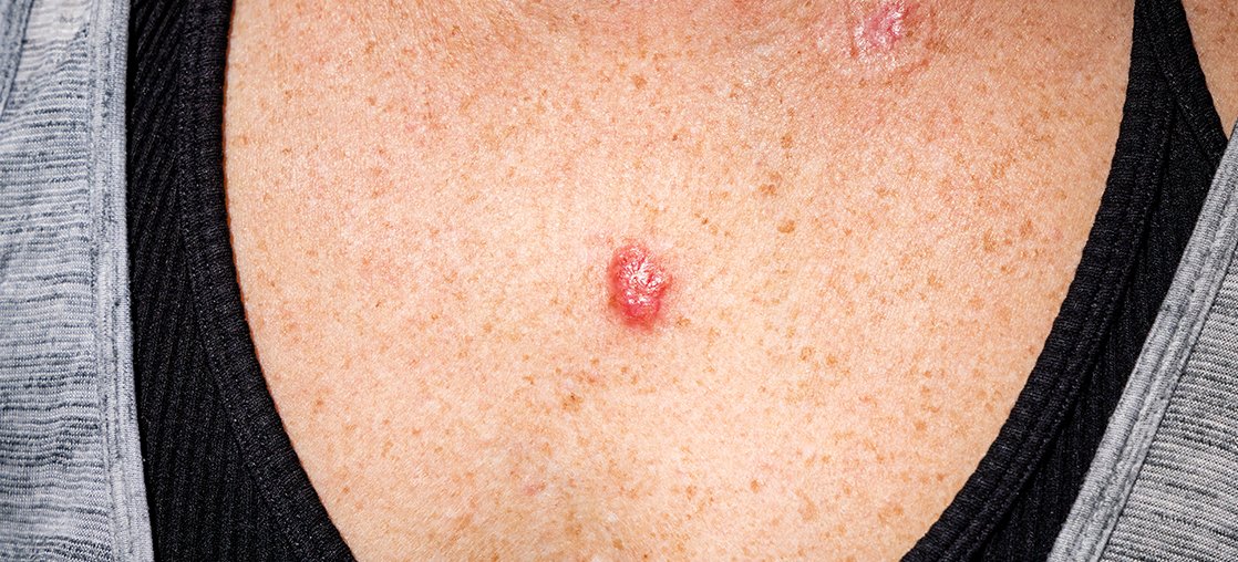 Basal Cell Carcinoma clinical study in Kentucky and NY