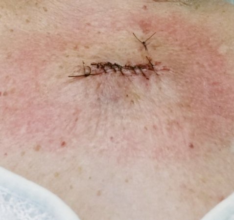 Basal Cell Carcinoma