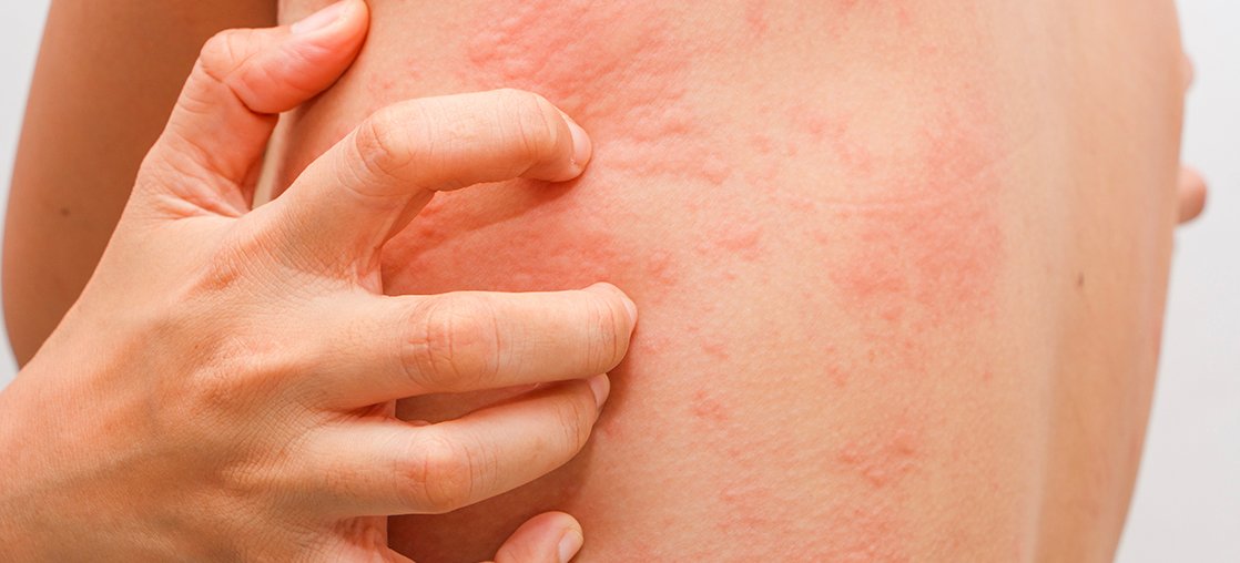Chronic Spontaneous Urticaria Clinical Trial Treatment in Kentucky and NY
