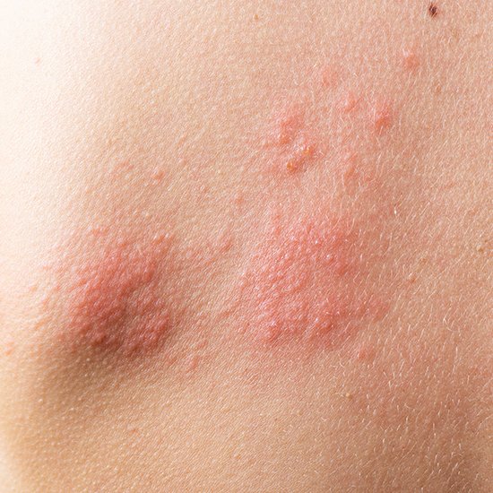 Chronic Spontaneous Urticaria study Bowling Green KY
