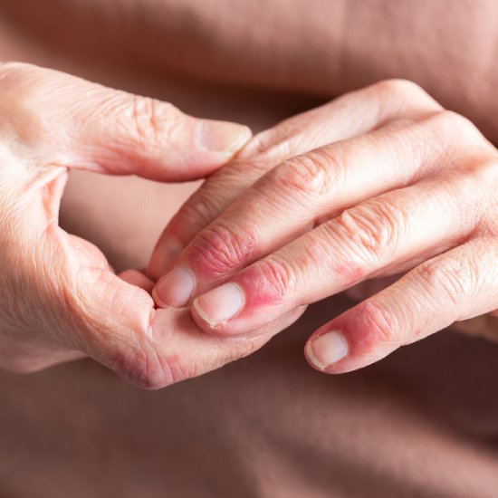 Eczema-Condition