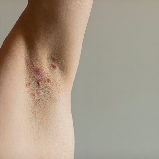 Hidradenitis Suppurativa clinical study Bowling Green KY