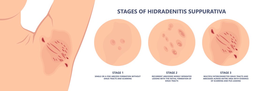 The stages of Hidradenitis Suppurativa treated at a clinical trial in Kentucky and NY