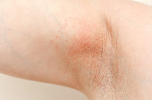 Hidradenitis Suppurativa