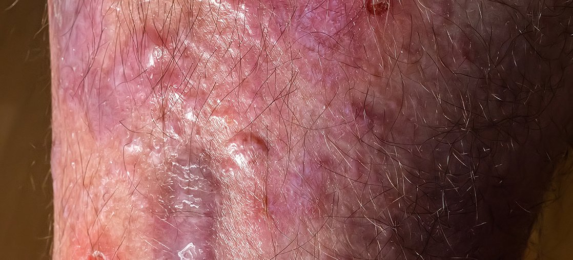 Lichen Planus Clinical Study Bowling Green KY