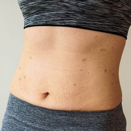 Lichen Planus Clinical Study Bowling Green KY