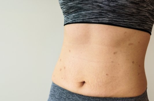 Lichen Planus