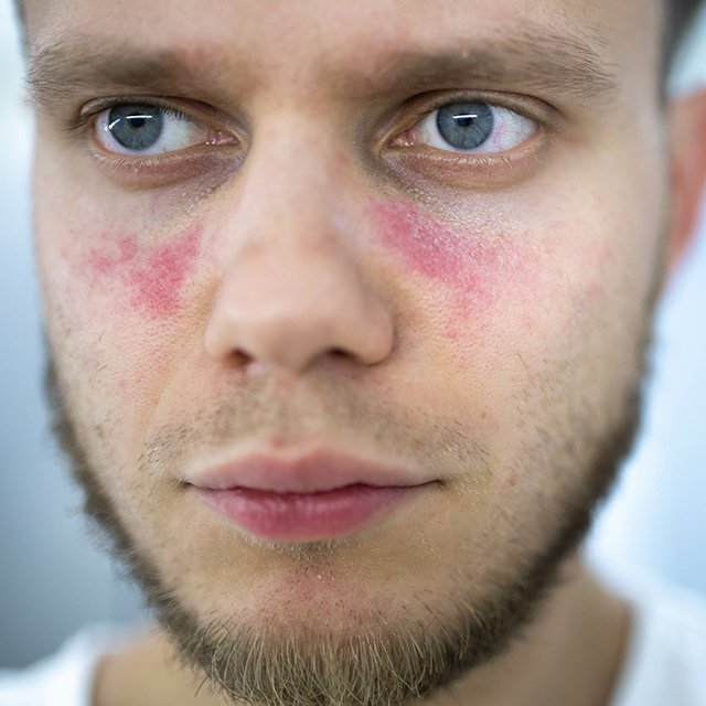 Man treated for Lupus in New York NY