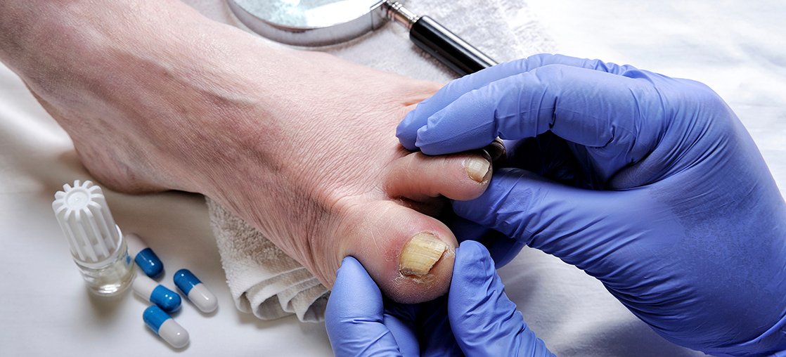 Onychomycosis clinical study in Bowling Green KY