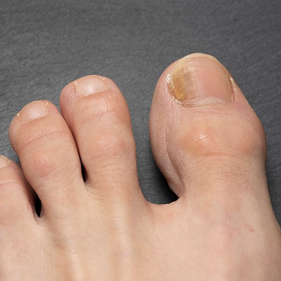 Onychomycosis clinical study in Bowling Green KY