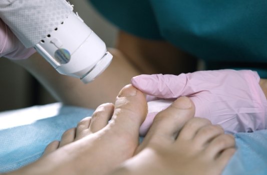 Onychomycosis