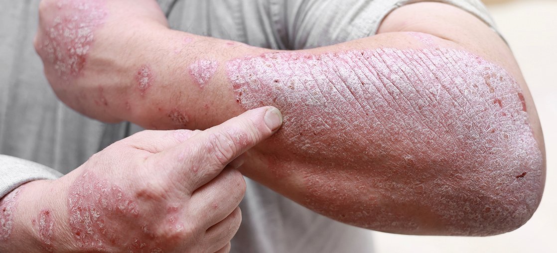 Psoriasis clinical study in Bowling Green KY