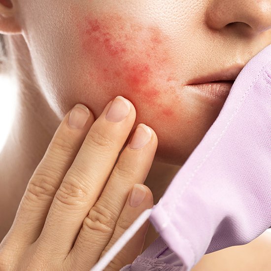 Rosacea clinical study Bowler Green KY