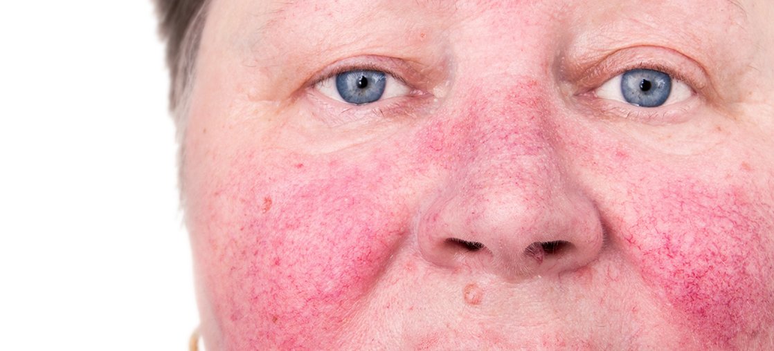 Rosacea clinical trial treatment in Kentucky and NY