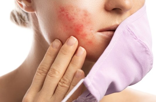 Rosacea