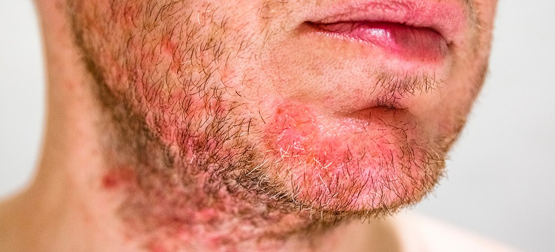 Seborrheic Dermatitis clinical study Bowling Green KY