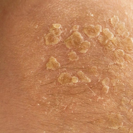 Seborrheic Dermatitis clinical study Bowling Green KY