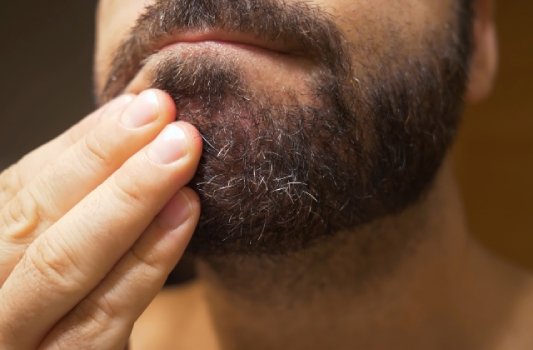 Seborrheic Dermatitis