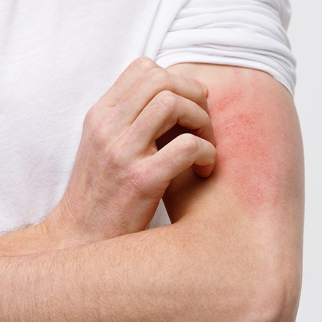 Treating itchiness at a clinical trial in New York NY
