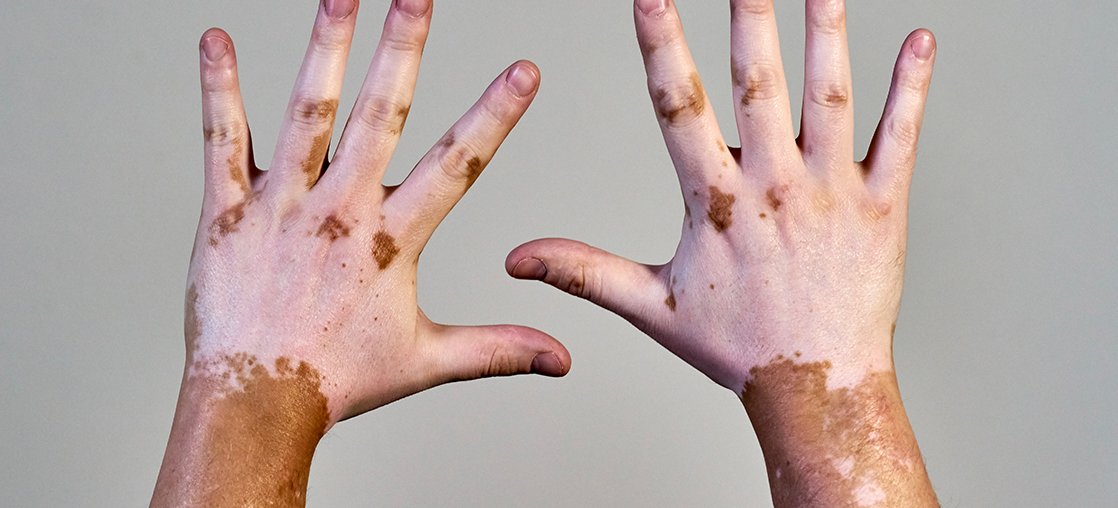 Vitiligo Clinical Study Bowling Green KY