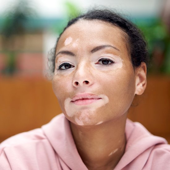 Vitiligo Clinical Study Bowling Green KY