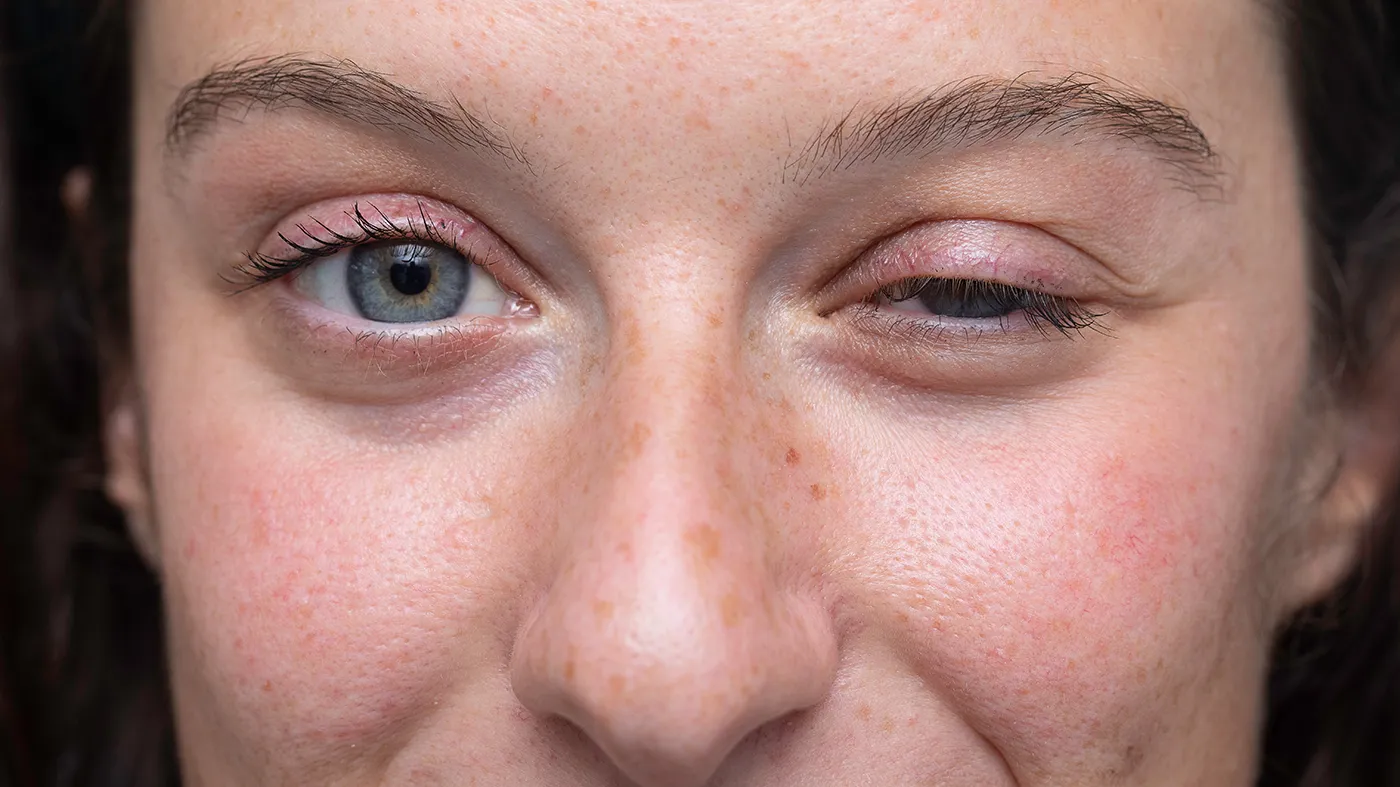 Close-up of ptosis in a patient, representing the condition targeted by Myasthenia Gravis clinical trials through Equity Medical's nationwide network.