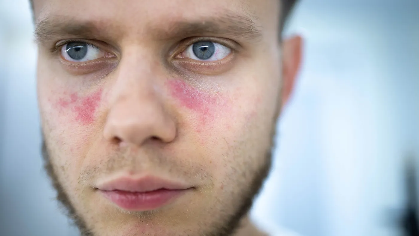 Male patient with redness on cheeks and under eyes, illustrating lupus symptoms and access to lupus clinical trials across the US with Equity Medical