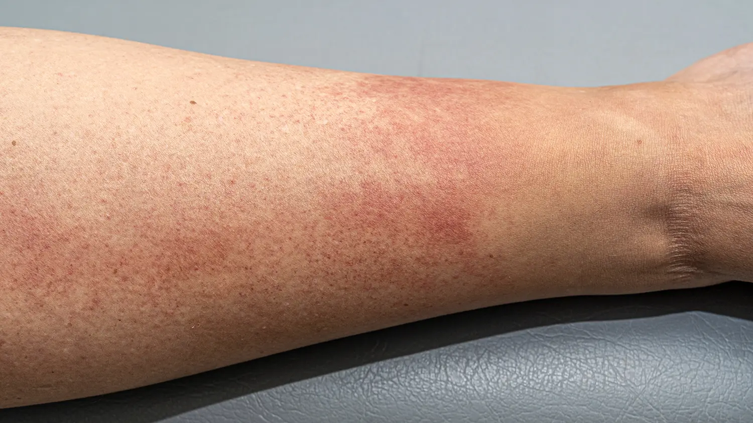Lower leg inflammation associated with vasculitis disorders during Equity Medical nationwide clinical trials research