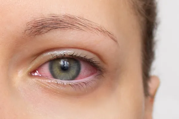Close-up of irritated red eye symptoms related to DED and dry eye disease clinical trials at Equity Medical.